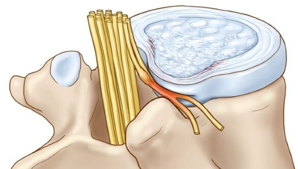 Protrusions of the intervertebral disc that occur with thoracic osteochondrosis compress the nerve endings