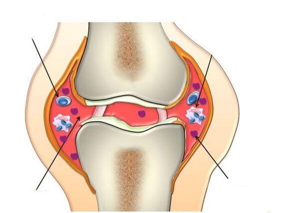 arthritic joint