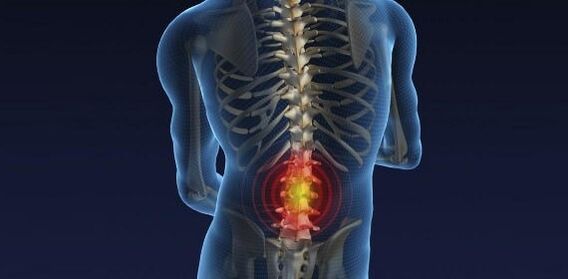 Back pain with osteochondrosis of the lumbar