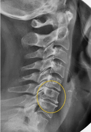 Osteochondrosis of the cervical spine on an X -ray
