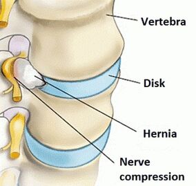 Osteochondrosis of the cervical region