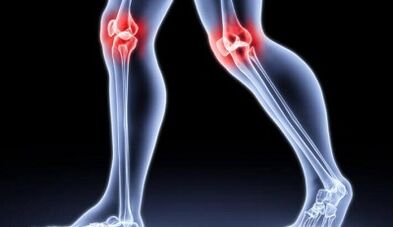 Prevention of the development of arthritis and arthrosis