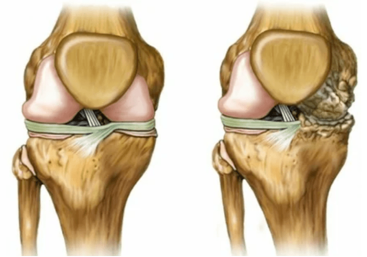 Stages of arthrosis