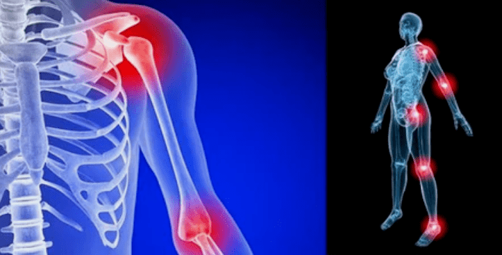 limb deformation for arthrosis