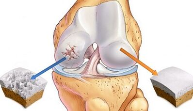 causes of arthrosis of the joints