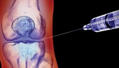 methods of treating joint arthrosis