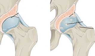 stages of development of hip arthrosis