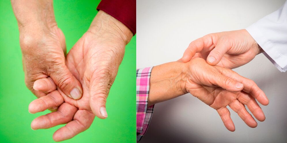 swelling and aching pains are the first signs of hand arthritis