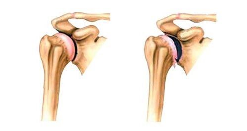 healthy and arthrotic shoulder joint