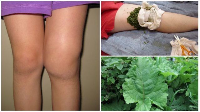 herbal compress for osteoarthritis of the knee