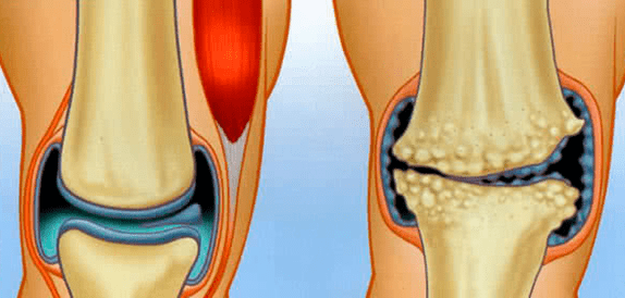 Normal joint and arthrosis